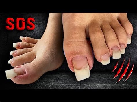 ⛔️ НЕ СТРИЖЕТ НОГТИ НА НОГАХ.😱 Врастание ногтевой пластины! Что делать ...