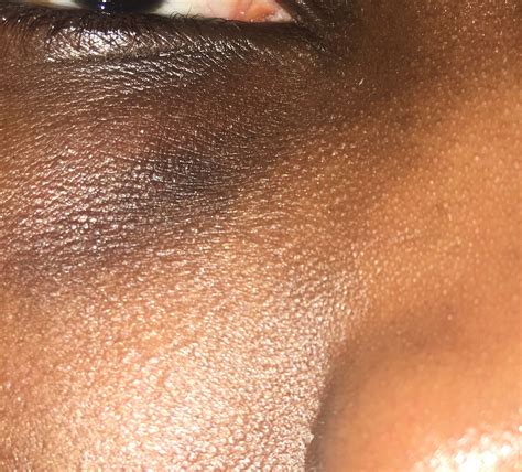 Under Eye Bumps, NOT milia - Beauty Insider Community