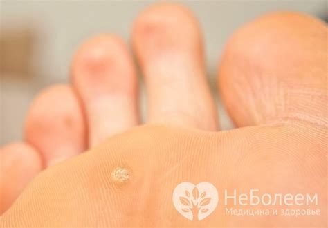 Подошвенная бородавка у ребенка: лечение, причины возникновения, фото