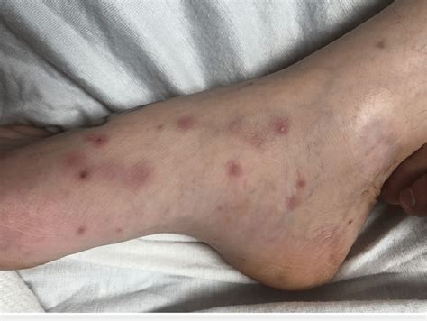 osler nodes   dark raised  purplish covering  medial