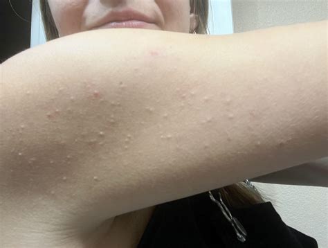white bumps  arms