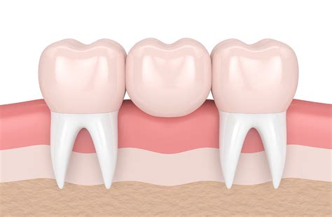 Dental Bridge Porcelain Santa Barbara CA