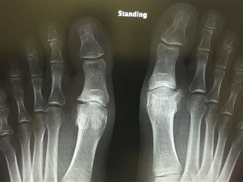 Minimally invasive Hallux Rigidus Osteotomy — David Redfern Surgery