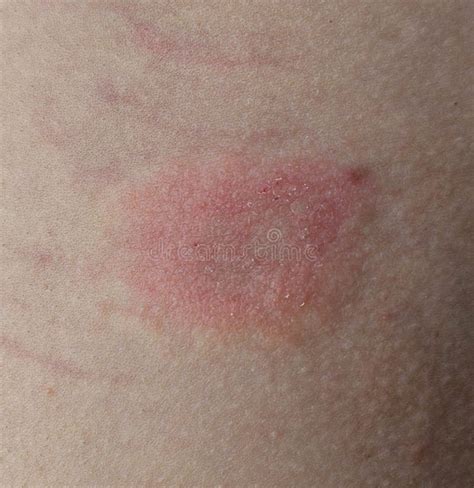 Parasitic Skin Rash Stock Photos - Free & Royalty-Free Stock Photos ...