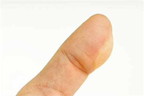 Een blaar bij het sporten; hoe voorkom je ze, wat is de juiste behandeling?