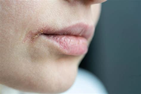 Герпес - что это такое, как он выглядит и какие есть виды герпесной ...