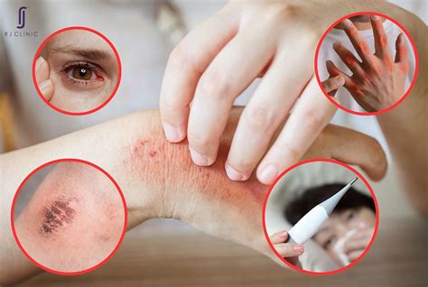 kayap punca simptom rawatan  perlu  tahu rj clinic