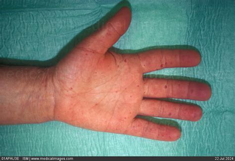 what is crest disease Crest syndrome: medlineplus medical encyclopedia ...