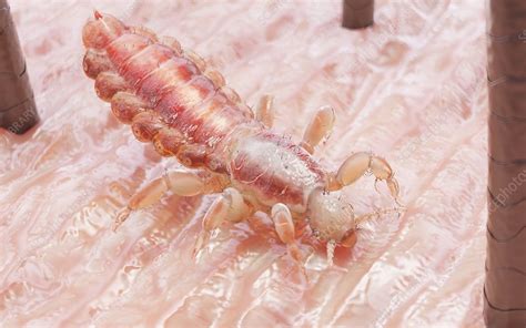 Head louse on a human head, illustration - Stock Image - F029/1140 ...