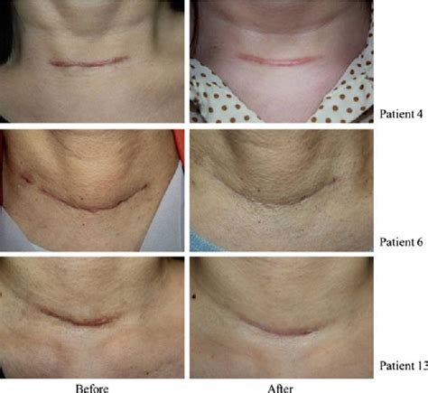 Table 1 from Appropriate Timing for Thyroidectomy Scar Treatment Using ...