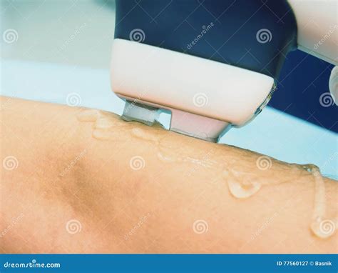 Epilation Van De Het Wapenverwijdering Van Het Laserhaar Behandeling in ...
