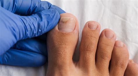 Onychomycosis: A Look Into This Nail Condition - HealthKart