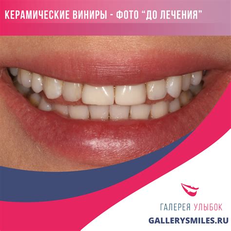 Керамические виниры на зубы E-max: особенности, отличия от аналогов