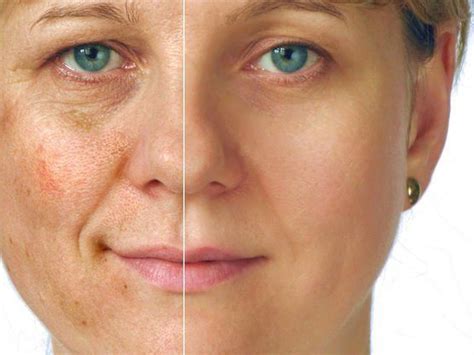 Как вывести пигментные пятна народными средствами. | Tache brune visage ...