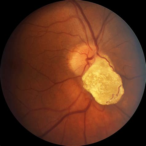 year  white female   retinal astrocytic hamartoma