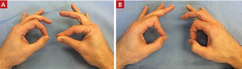 Anterior Interosseous Nerve Syndrome