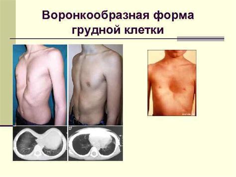 Осмотр грудной клетки Конституционные типы: n астеник
