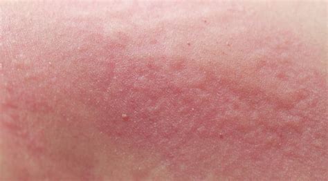 penyakit ruam kulit homecare