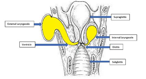 Larynx - LARYNGOCELE - Dr. Meenesh Juvekar - ENT Specialist