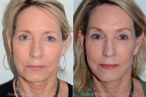 Brow Lift Miami - Lift Your Look with Dr. Bustillo