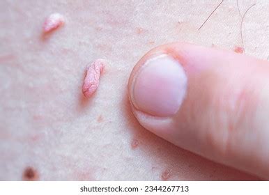 Hpv On Men Photos and Images | Shutterstock