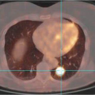 PET scan of the lung showing an increased SUV uptake in a SPN 2 x 2 × ...