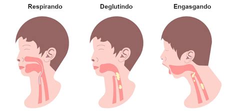 Engasgo Com Saliva E Falta De Ar - Engasgo: o que é, sinais, primeiros socorros - Mundo Educação