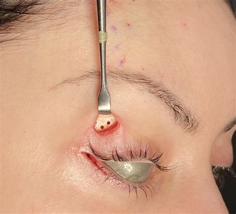 The Fundamental Techniques in Cat Eye Reshaping Surgery - Explore ...