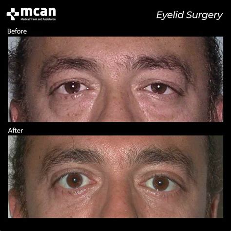 Eyelid Surgery Turkey | Best Clinic and Cost 2023