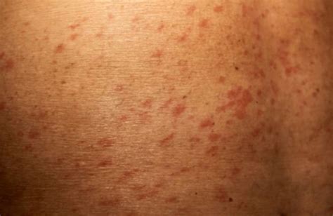 Токсикодермія лікування в Києві на Печерську - Derm.Com