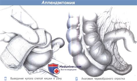 Показания, этапы и техника операции при аппендиците - аппендэктомии