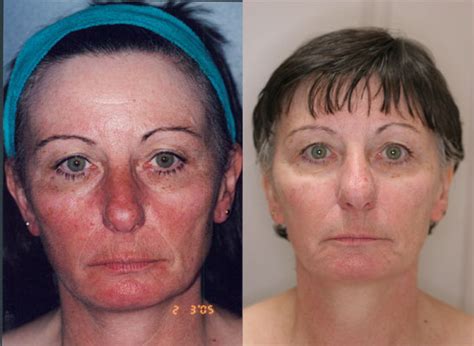 Laser Surgery: Laser Surgery Rosacea Causes Of Nose Redness