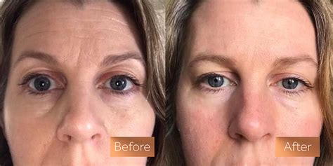 How Long Does It Take For Collagen To Work | Absolute Collagen