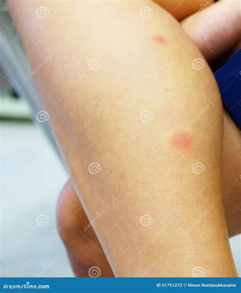 Red Rash Stock Photo | CartoonDealer.com #51751272