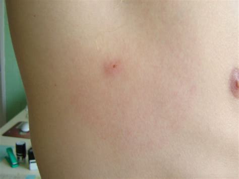 A Lyme-folt megjelenési formái - Istenhegyi Géndiagnosztika