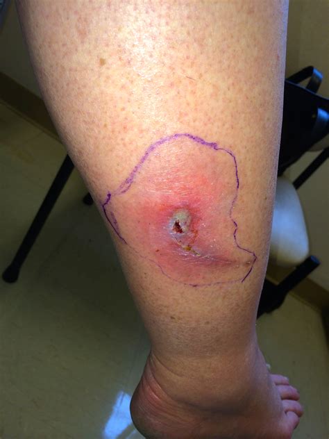 Mercer Infection Knee
