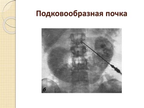 Пороки развития мочеполовой системы - презентация онлайн