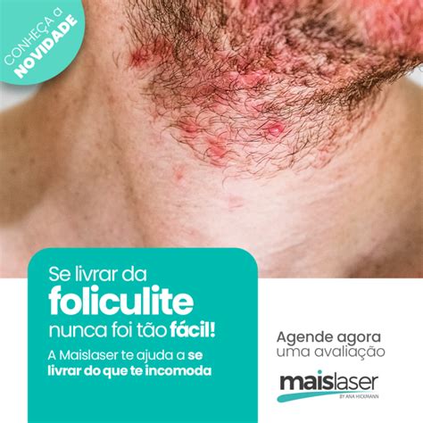 O Que Passar Na Foliculite - Tratamento de Foliculite - Maislaser by Ana Hickmann Itatiba
