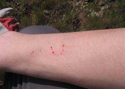 How to Survive a Venomous Snake Bite