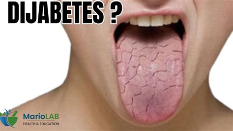 Dijabetes: simptomi bolesti - YouTube