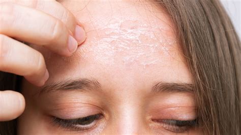 skin   forehead   flaking