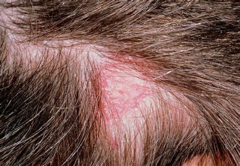 Tinea Capitis vs. Seborrheic Dermatitis – DS Healthcare Group