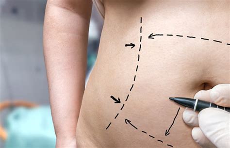 Permanent Fat Removal Methods – Research & Development at SCA!