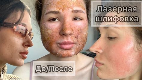 Лазерная шлифовка лица лазером CO2 | Весь процесс реабилитации | До и ...