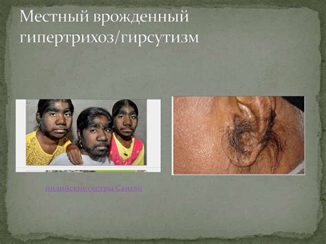 Гирсутизм и гипертрихоз - презентация онлайн