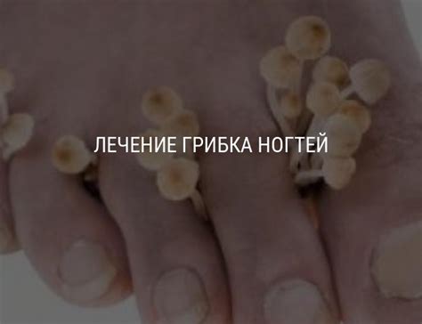 Чем лечить грибок ногтей: лекарства, мази, лазер и средства народной ...