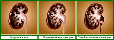 Гидронефроз почек: симптоматика, причины, лечение