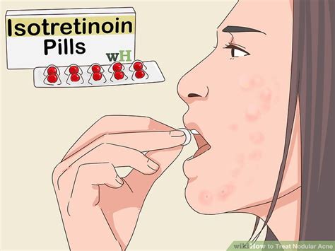 how to treat nodular acne at home