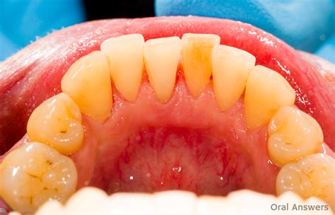how to remove calculus on teeth at home 5