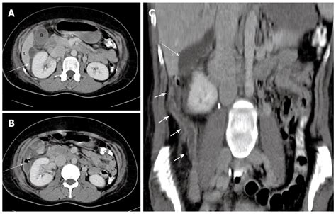 Ascending retrocecal appendicitis presenting with right upper abdominal ...